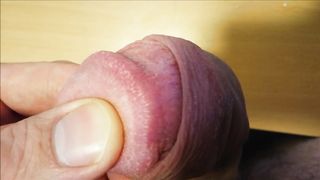 How to Remove Pearly Penile Papules for FREE (Hirsuties Coronae Glandis)