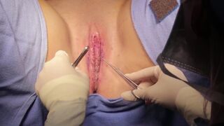 Labiaplasty Surgery