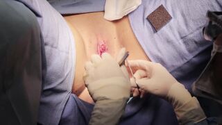 Labiaplasty Surgery