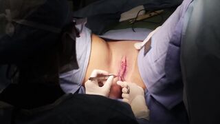 Labiaplasty Surgery