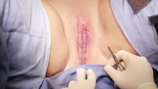 Labiaplasty Surgery