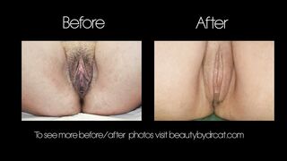 Labiaplasty Surgery