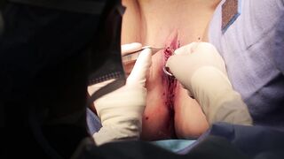 Labiaplasty Surgery