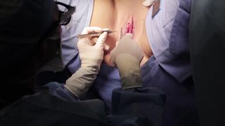 Labiaplasty Surgery